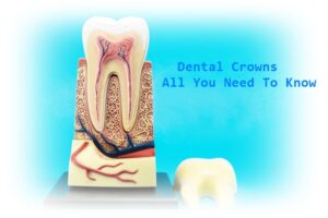 Dental Crown - All You Need to Know