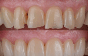veneers teeth treatment