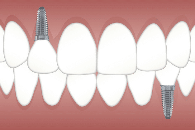 Dental-Implants- Sugar-land