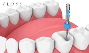 root canal therapy sugar land