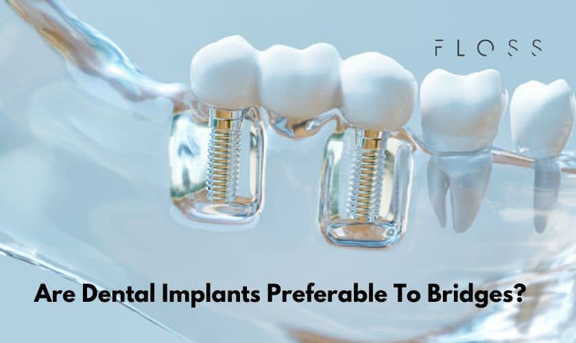 Dental-Implants-Preferable-To-Bridges