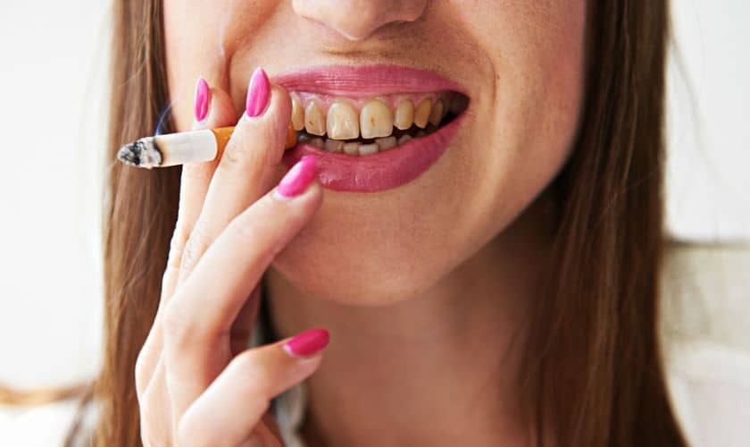 Teeth-Whitening-If-You-Are-On-Tobacco