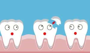 Options-for-Restoring-a-Chipped-Tooth