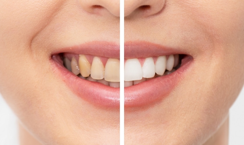 Are You Ready For Teeth Whitening?