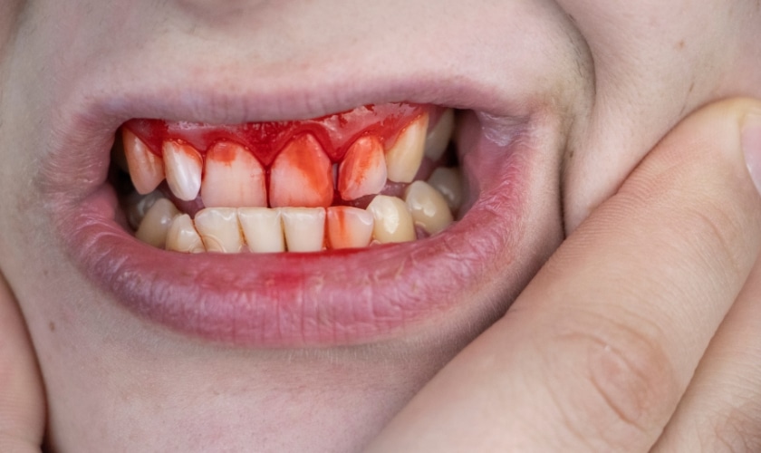 8 Common Causes of Bleeding Gums and Treatment