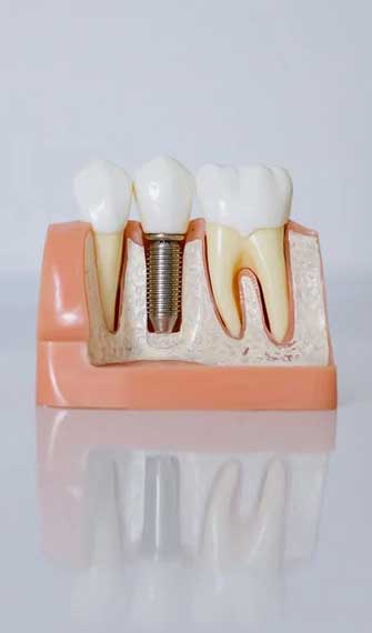 Dental Implants Sugar Land TX at FLOSS Dental Sugar Land
