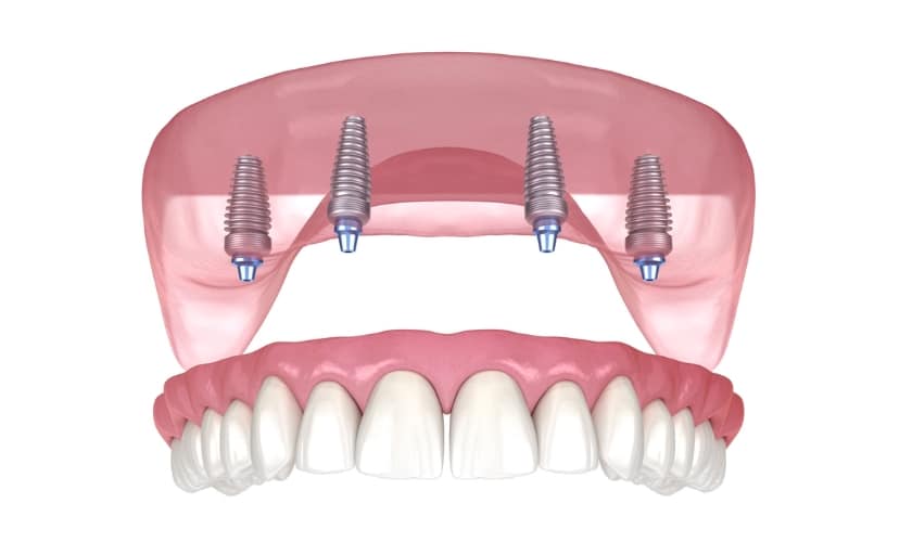 Alternatives of Dental Implants