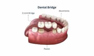 Dental Bridge is the common alternatives of dental implant