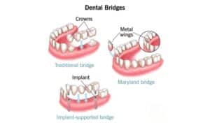 Types of dental bridges- FLOSS Dental Sugar Land