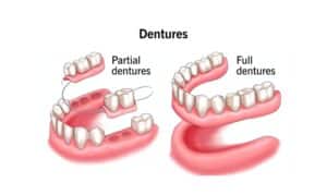 Types of Dentures in Sugar land