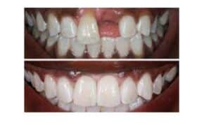 Additional choice that can improve your smile without surgery is veneers