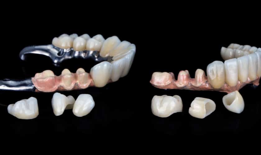 Illustration comparing porcelain and metal dental crowns, representing the options available for patients in Sugar Land to choose the best crown for their oral health needs.