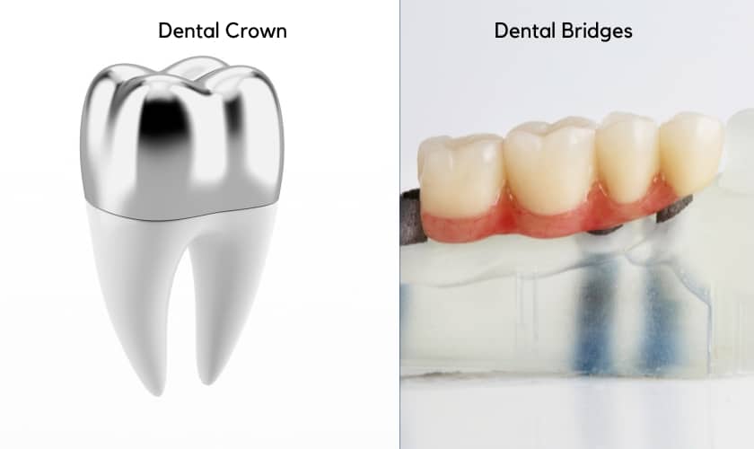 Dental Crowns vs. Dental Bridges Pros and Cons