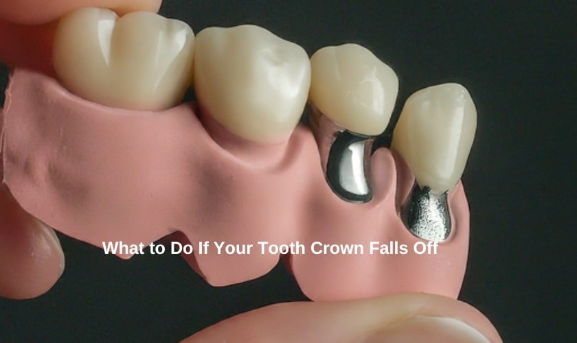 What to Do If Your Tooth Crown Falls Off